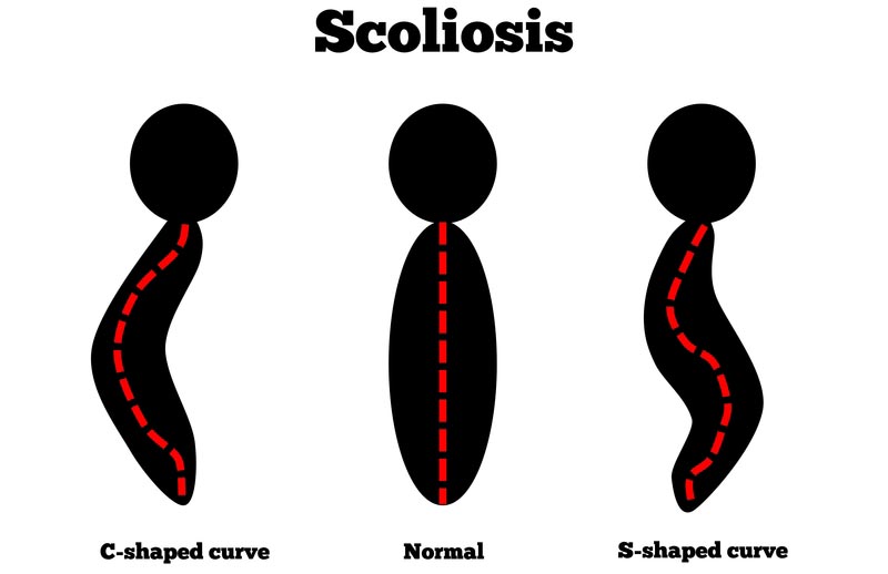 Shelton, WA scoliosis treatment
